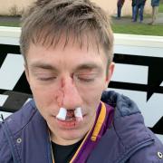 Marr's Richard Dalgleish suffered a broken nose.
